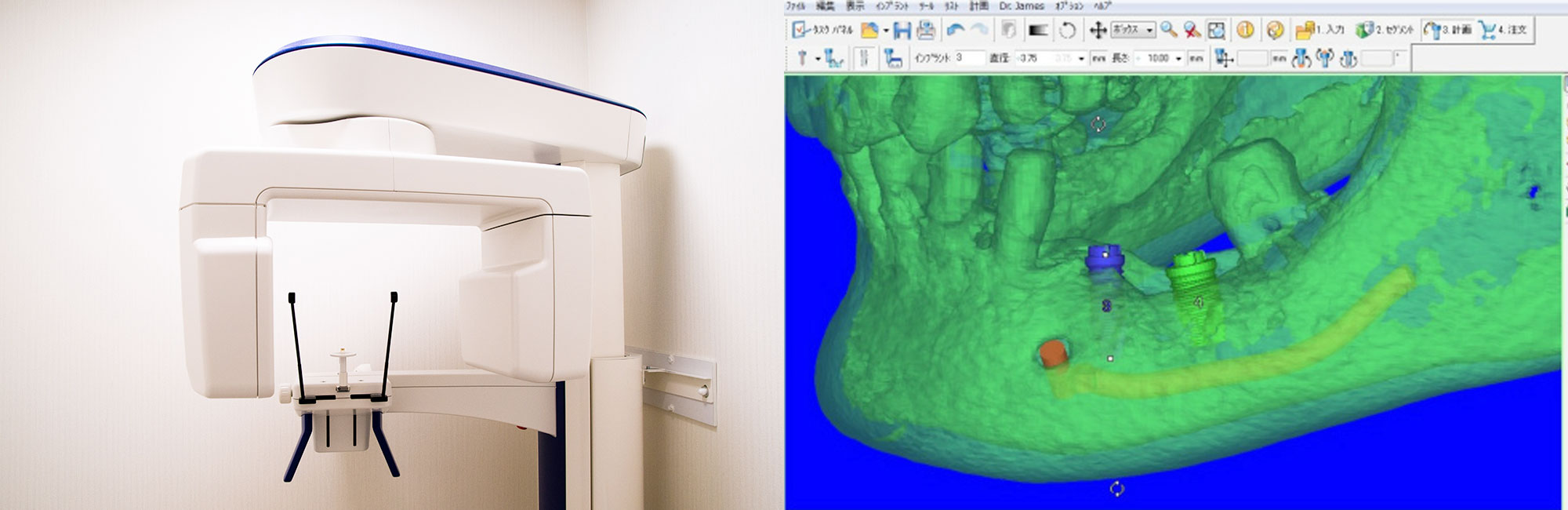 歯科用CT(3D画像診断装置)